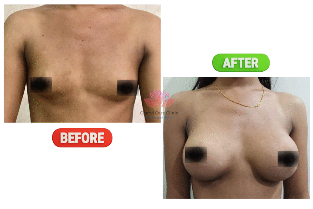 Breast Implant Surgery in Thane: Types, Cost & Best Options Explained